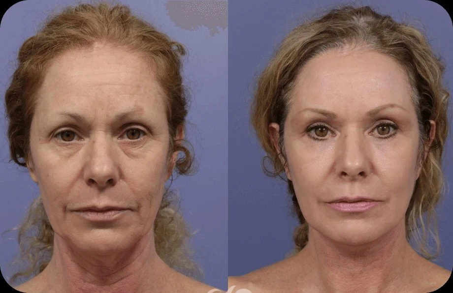 Before and after illustration for Synevra Lift & Lock System — results may vary